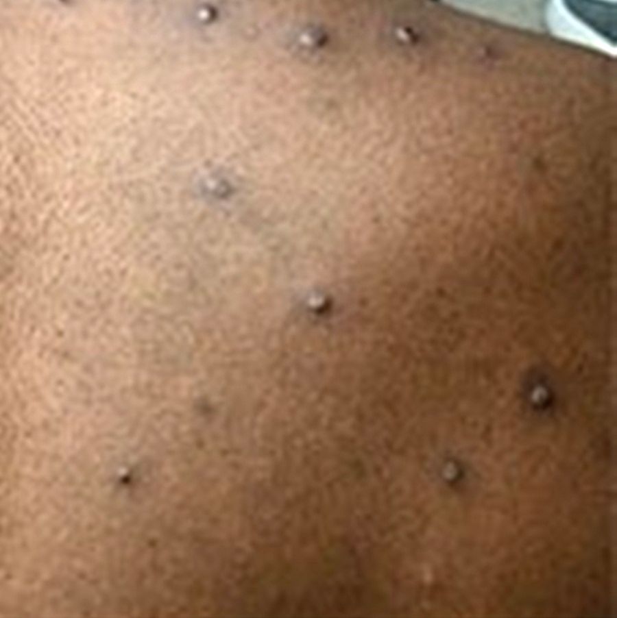 Recent Monkeypox Rash Monkeypox scare: Man in TN with skin rash kept in isolation