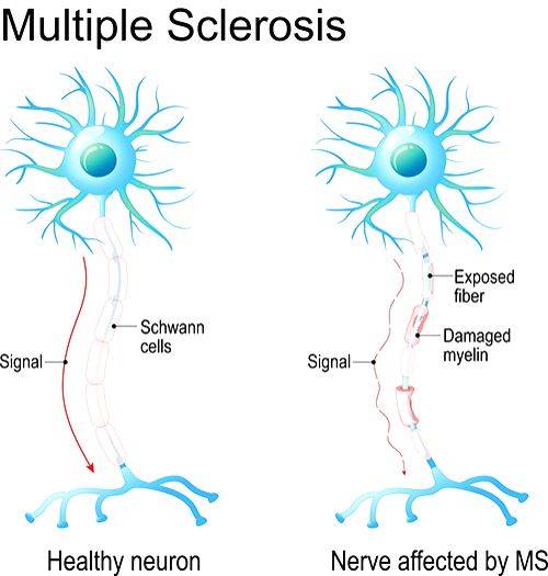 New stem cell therapy may halt multiple sclerosis progression